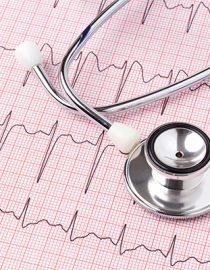 atrial fibrillation image